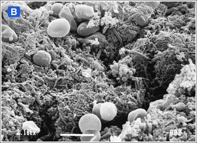 図２:歯肉縁下プラークにおける細菌叢の遷移（走査電子顕微鏡写真）B