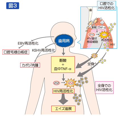 図3：歯周病による局所（口腔）と全身でのエイズ進展の可能性