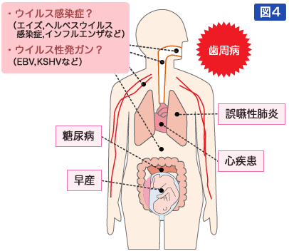 図4：歯周病が誘因となる全身疾患