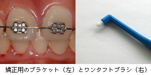 ブラケットのついている歯とワンタフトブラシ